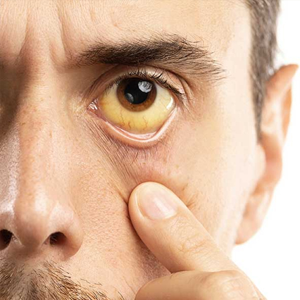 Jaundice treatment in Pune